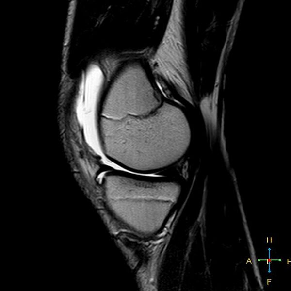 File:Anterior cruciate ligament tear - complete (Radiopaedia 24907-25170 Sagittal T2 14).jpg