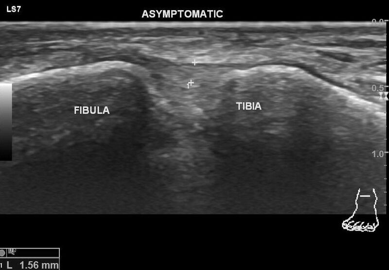 File:Anterior inferior tibiofibular ligament injury (Radiopaedia 65077-74073 B 2).jpg