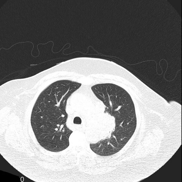 File:Aortic arch false aneurysm (Radiopaedia 14667-14587 Axial lung window 9).jpg