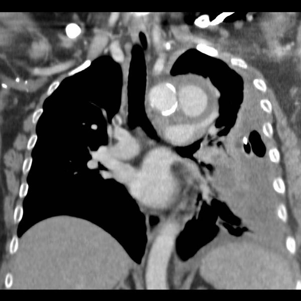 File:Aortic arch false aneurysm (Radiopaedia 14667-14588 B 9).jpg