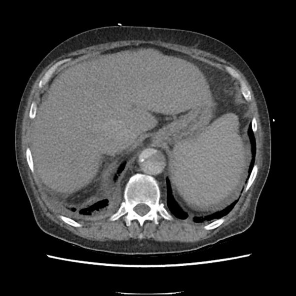 File:Aortic arch graft infection (FDG PET-CT) (Radiopaedia 71975-82437 A 57).jpg