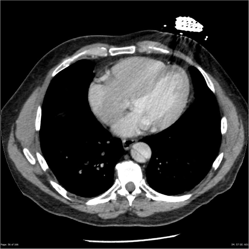 Aortic dissection- Stanford A (Radiopaedia 37759-39664 A 47).jpg