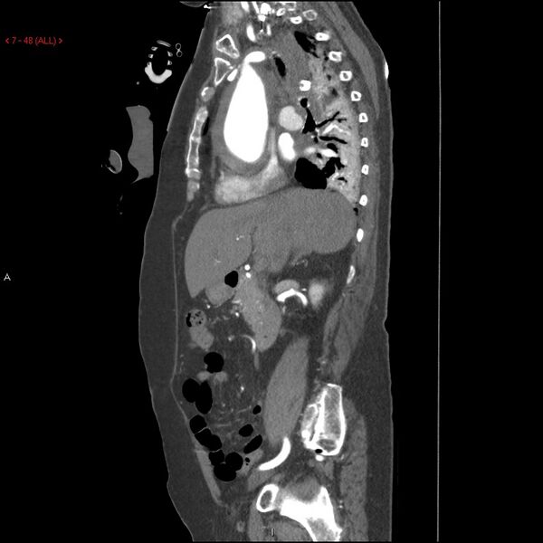 File:Aortic intramural hematoma (Radiopaedia 27746-28001 C 17).jpg