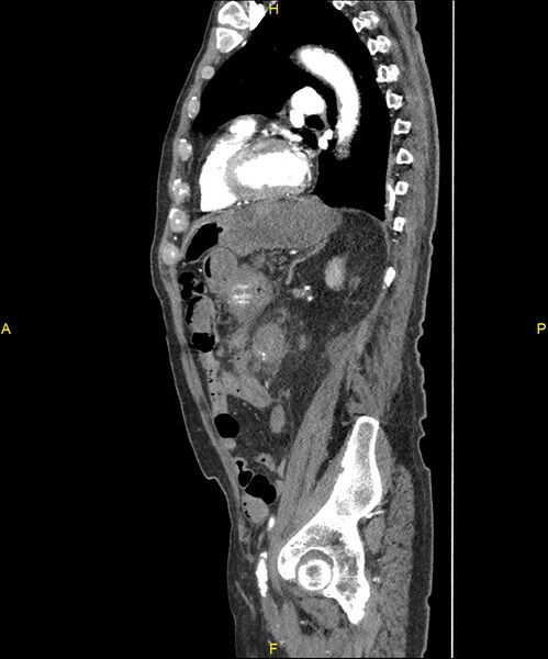 File:Aortoenteric fistula (Radiopaedia 84308-99603 C 227).jpg
