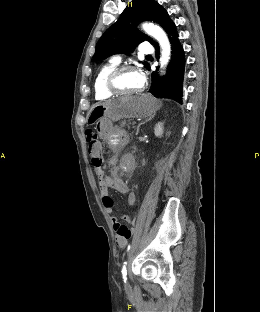 Aortoenteric fistula (Radiopaedia 84308-99603 C 227).jpg