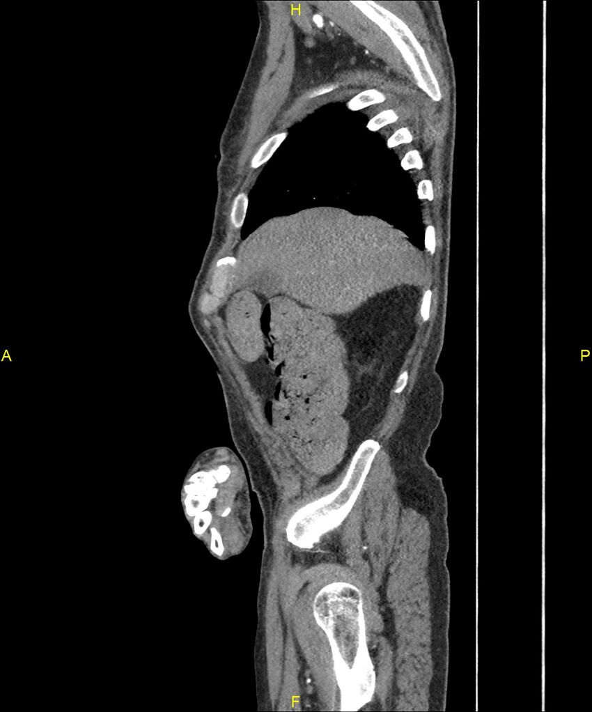Aortoenteric fistula (Radiopaedia 84308-99603 C 57).jpg