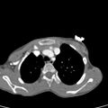 Aortopulmonary window, interrupted aortic arch and large PDA giving the descending aorta (Radiopaedia 35573-37074 B 18).jpg