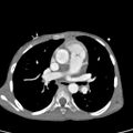 Aortopulmonary window, interrupted aortic arch and large PDA giving the descending aorta (Radiopaedia 35573-37074 B 42).jpg