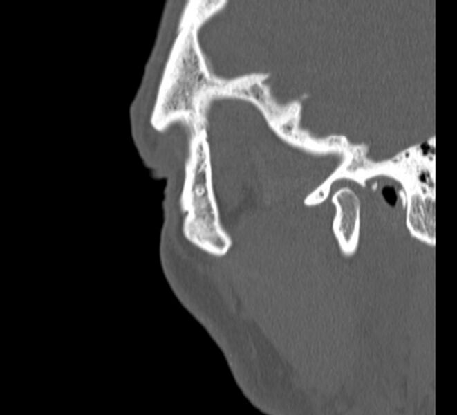 File:Aplastic maxillary sinuses (Radiopaedia 60030-67561 Sagittal bone window 34).jpg