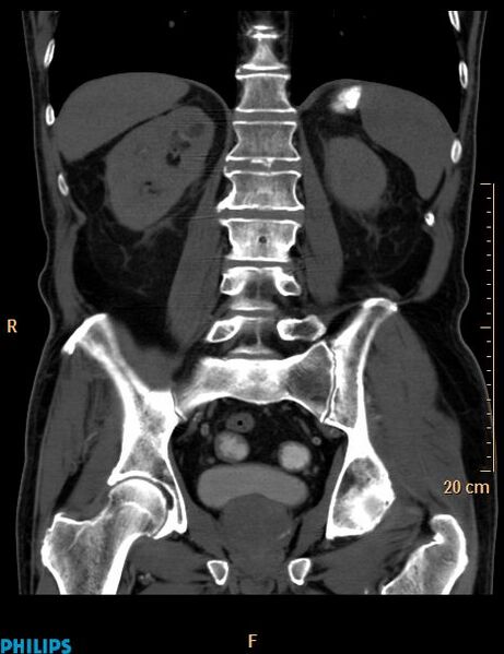File:Appendiceal mucocoele (Radiopaedia 29449-29917 E 3).jpg