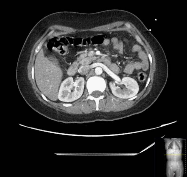 File:Appendicitis (CT angiogram) (Radiopaedia 154713-127660 Axial 127).jpg