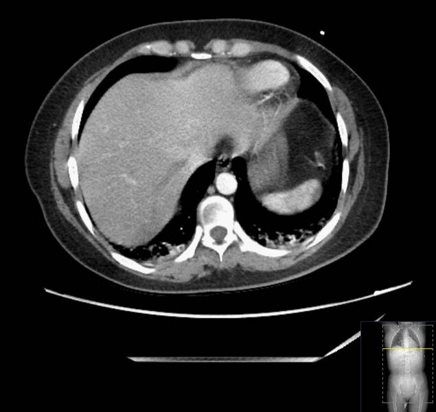 File:Appendicitis (CT angiogram) (Radiopaedia 154713-127660 Axial 173).jpg
