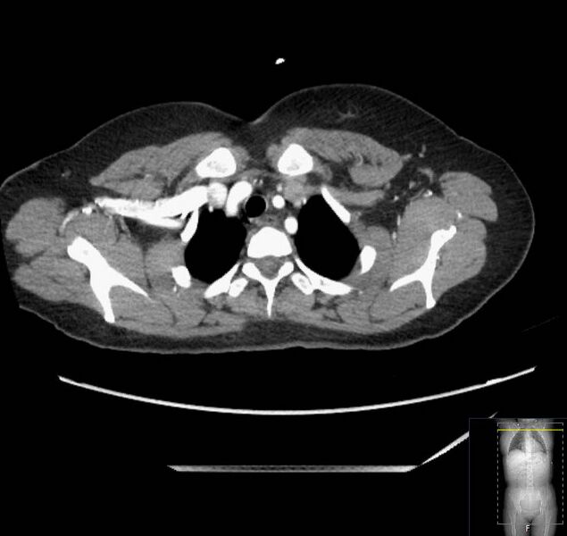 File:Appendicitis (CT angiogram) (Radiopaedia 154713-127660 Axial 232).jpg