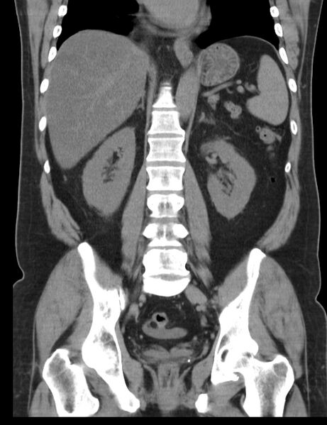 File:Appendicitis and giant appendicolith (Radiopaedia 80251-93588 Coronal non-contrast 30).jpg