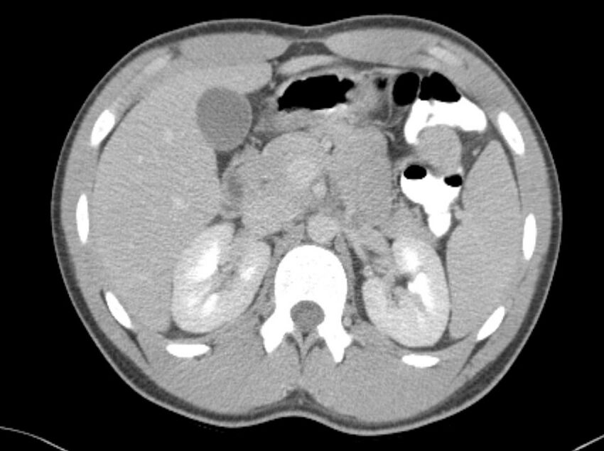 Appendicitis and incidental foregut duplication cyst (Radiopaedia 52962-58916 A 9).jpg