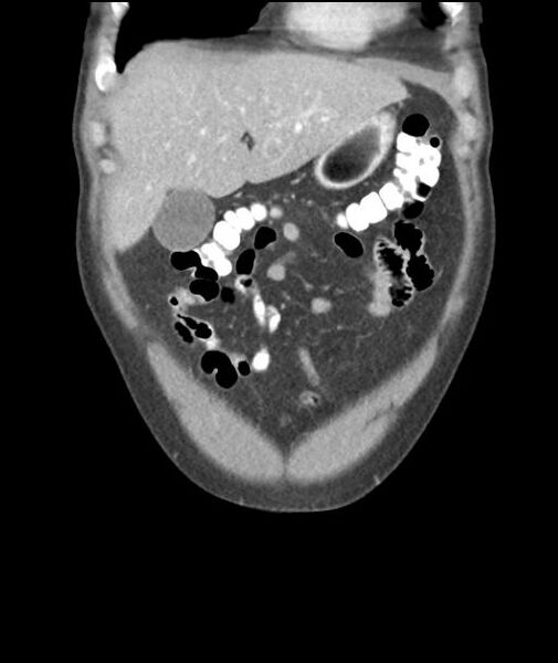 File:Appendicitis with cecal bar sign (Radiopaedia 31878-32830 A 16).jpg