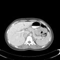 Appendicitis with minimal stranding but appendicolith (Radiopaedia 29035-29397 A 21).jpg