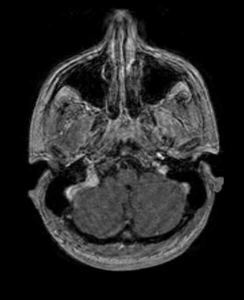 File:Arachnoid cyst- extremely large (Radiopaedia 68741-78451 Axial T1 C+ 16).jpg