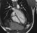 Arrhythmogenic right ventricular cardiomyopathy (Radiopaedia 39806-42237 D 137).jpg