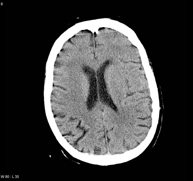 File:Arteriovenous malformation - cerebral (Radiopaedia 8172-9020 Axial non-contrast 14).jpg