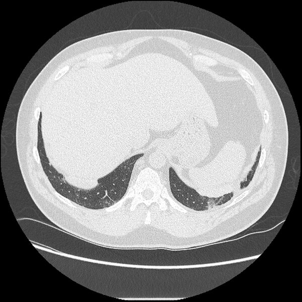 File:Asbestosis (Radiopaedia 45002-48961 Axial lung window 43).jpg