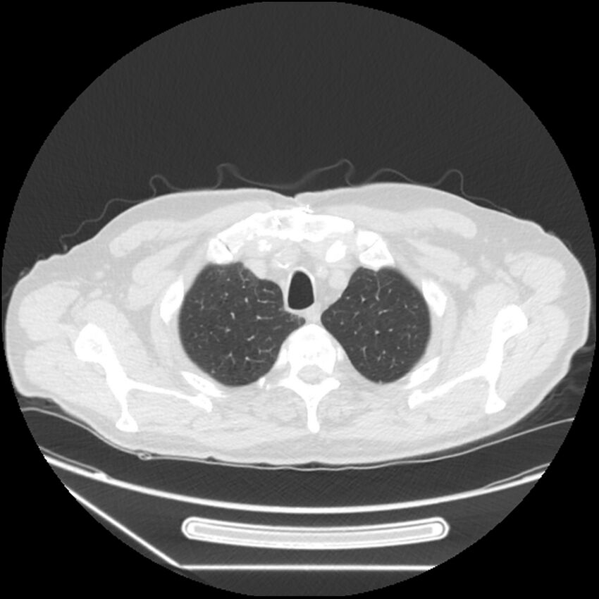 Asbestosis complicated by lung cancer (Radiopaedia 45834-50116 Axial lung window 10).jpg