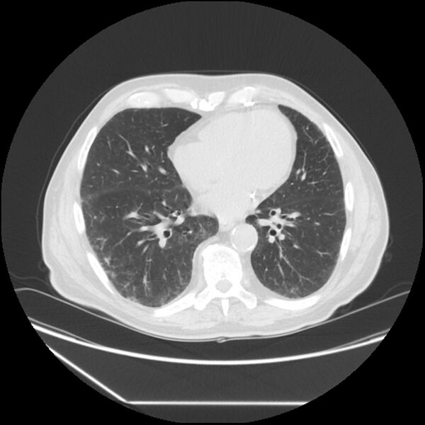 File:Asbestosis complicated by lung cancer (Radiopaedia 45834-50116 Axial lung window 44).jpg