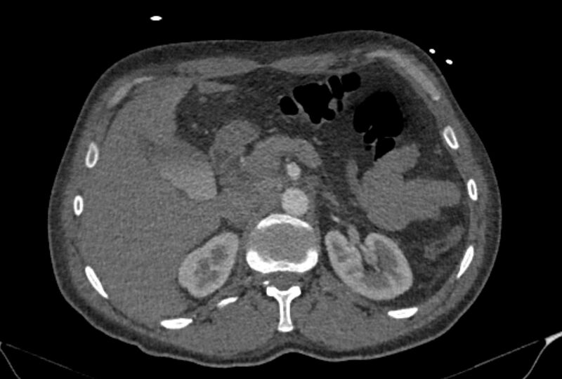 File:Ascending aortic aneurysm (Radiopaedia 86279-102297 C 74).jpg