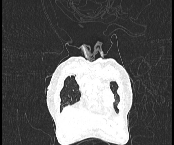 File:Aspergillomas (Radiopaedia 66779-76110 Coronal lung window 1).jpg