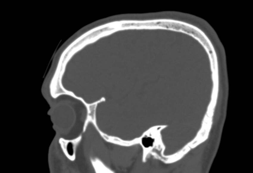 Asymptomatic occipital spur (Radiopaedia 87753-104201 Sagittal bone window 63).jpg