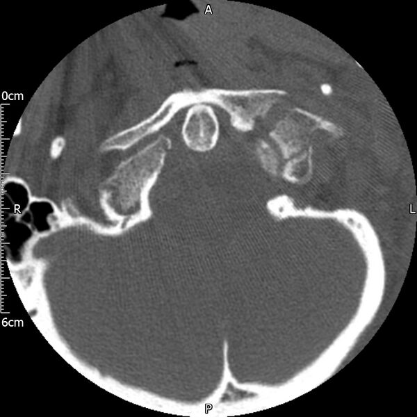 File:Atlas fracture with Currarino type A congenital defect (Radiopaedia 71747-82144 Axial bone window 25).jpg