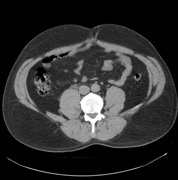 File:Atrophic kidney due to severe chronic obstructive hydronephrosis (Radiopaedia 40828-43474 Axial non-contrast 20).jpg