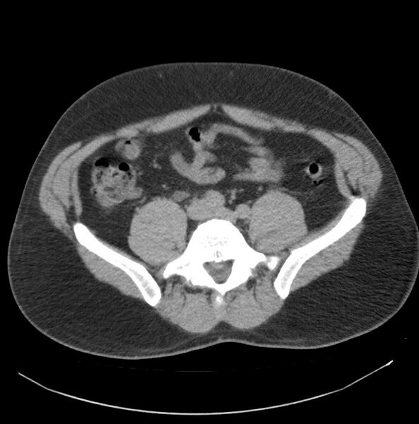 File:Atrophic kidney due to severe chronic obstructive hydronephrosis (Radiopaedia 40828-43474 Axial non-contrast 25).jpg