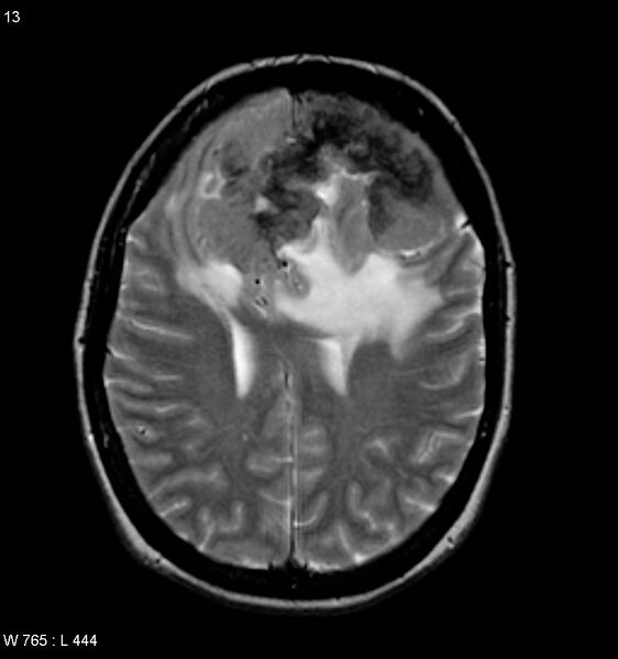 File:Atypical meningioma (WHO grade II) (Radiopaedia 7762-8586 Axial T2 5).jpg