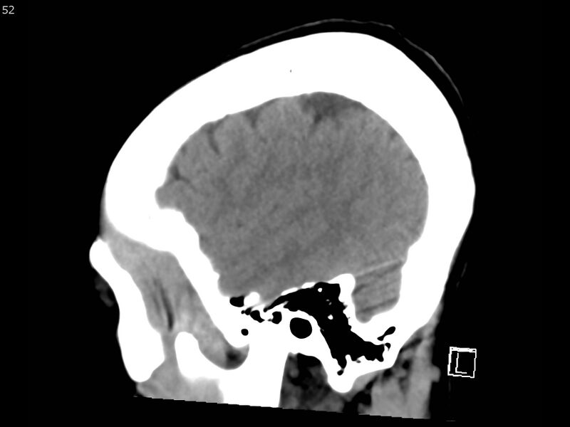 File:Atypical meningioma - intraosseous (Radiopaedia 64915-73867 C 50).jpg