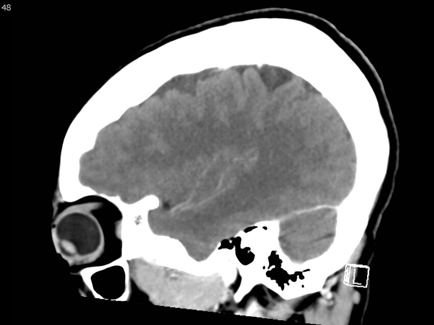 Atypical meningioma - intraosseous (Radiopaedia 64915-73867 F 47).jpg