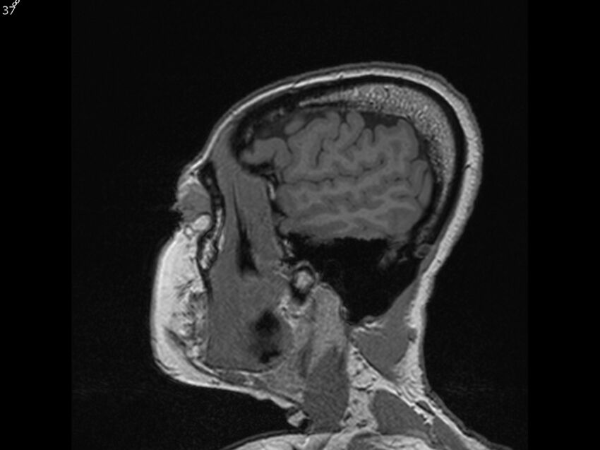 Atypical meningioma - intraosseous (Radiopaedia 64915-74572 Sagittal T1 37).jpg