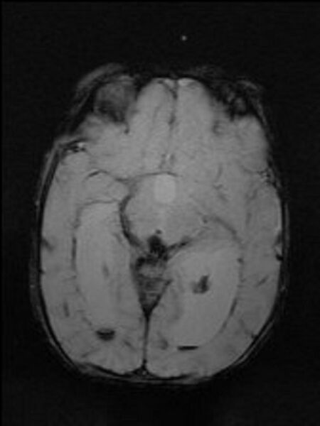 File:Atypical teratoid rhabdoid tumor (prenatal US and neonatal MRI) (Radiopaedia 59091-66388 Axial Gradient Echo 2).jpg