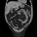 Autosomal dominant polycystic kidney disease (Radiopaedia 36539-38101 C 20).jpg