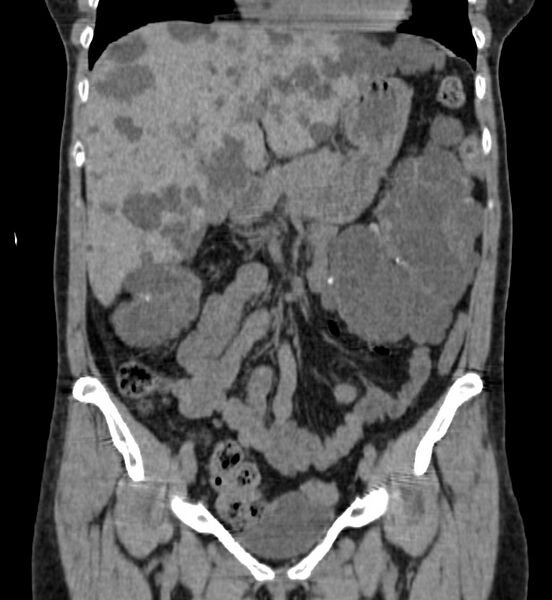 File:Autosomal dominant polycystic kidney disease (Radiopaedia 41918-44922 Coronal non-contrast 11).jpg