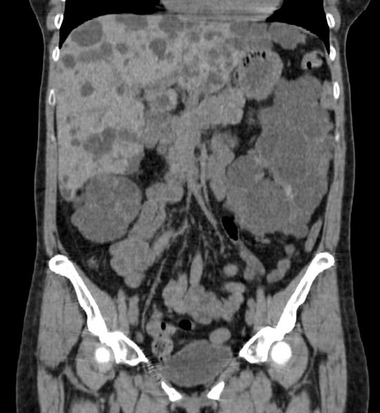 File:Autosomal dominant polycystic kidney disease (Radiopaedia 41918-44922 Coronal non-contrast 13).jpg