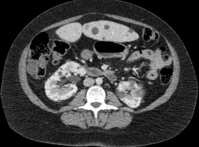 File:Autosomal dominant polycystic kidney disease (Radiopaedia 57124-64017 A 60).jpg