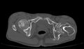Avascular necrosis of the left hip (Radiopaedia 75068-86125 Axial bone window 67).jpg