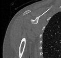 Avulsion fracture - greater tuberosity of humerus (Radiopaedia 71216-81514 Coronal bone window 40).jpg