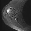 Avulsion fracture - greater tuberosity of humerus (Radiopaedia 71216-81515 Axial PD fat sat 8).jpg