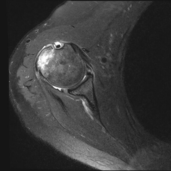 File:Avulsion fracture - greater tuberosity of humerus (Radiopaedia 71216-81515 Axial PD fat sat 8).jpg