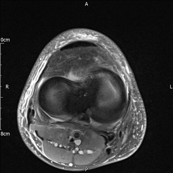 File:Avulsion fracture of the fibular head (Radiopaedia 74804-85808 Axial PD fat sat 23).jpg
