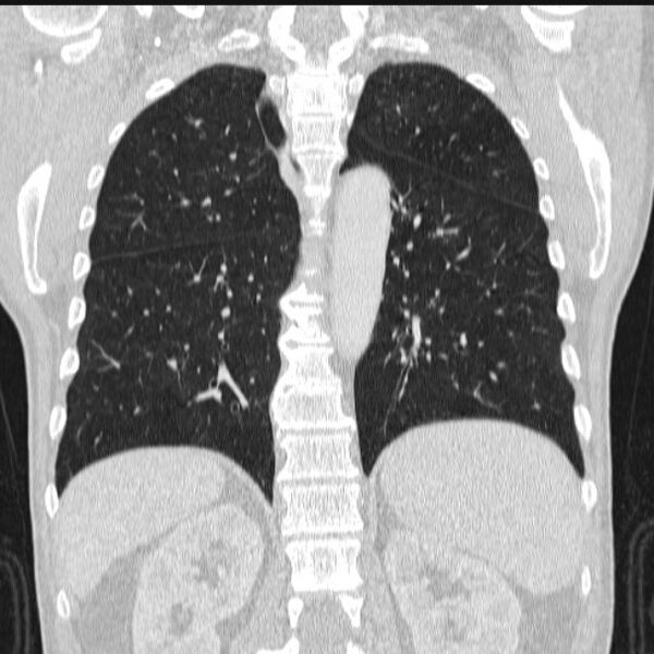 File:Azygos lobe (Radiopaedia 38259-40275 Coronal lung window 56).jpg