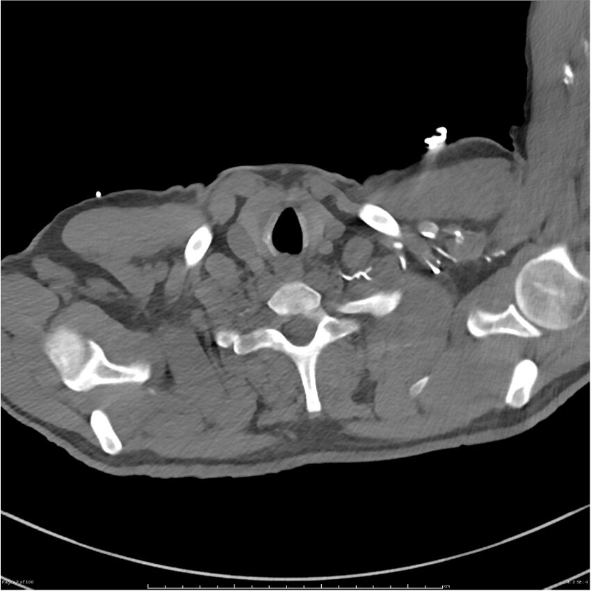 Azygos venous system anatomy (CT pulmonary angiography) (Radiopaedia 25928-26077 Axial C+ CTPA 2).jpg