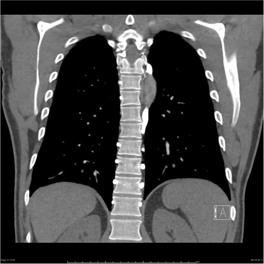 Azygos venous system anatomy (CT pulmonary angiography) (Radiopaedia 25928-26077 Coronal C+ CTPA 57).jpg